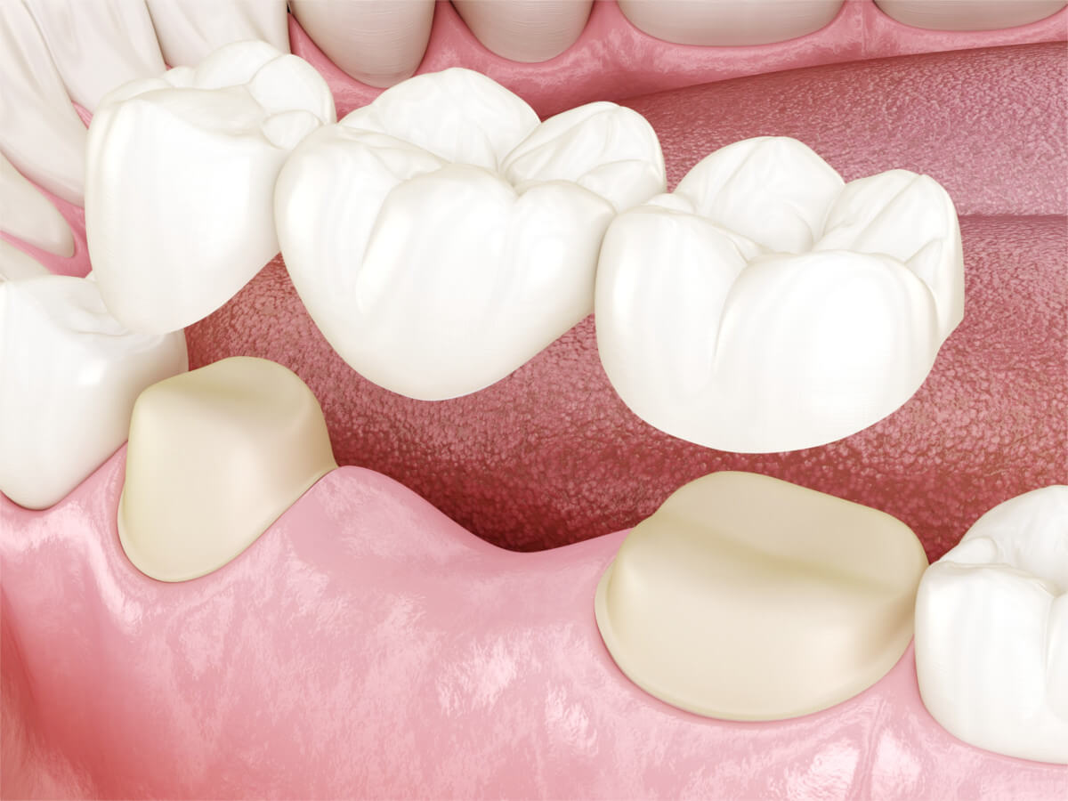 Puente Sobre Implantes Dentales Clinica Dental Palomero