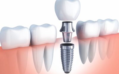 Las ventajas reales de los Implantes Dentales