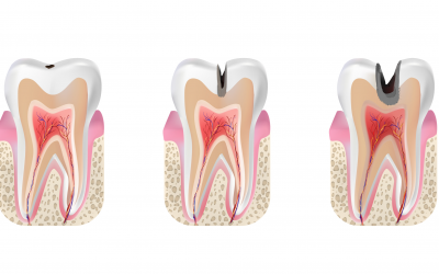 Consejos para evitar las caries