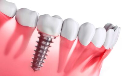 Implantes o puentes dentales: ¿qué es mejor para mí?