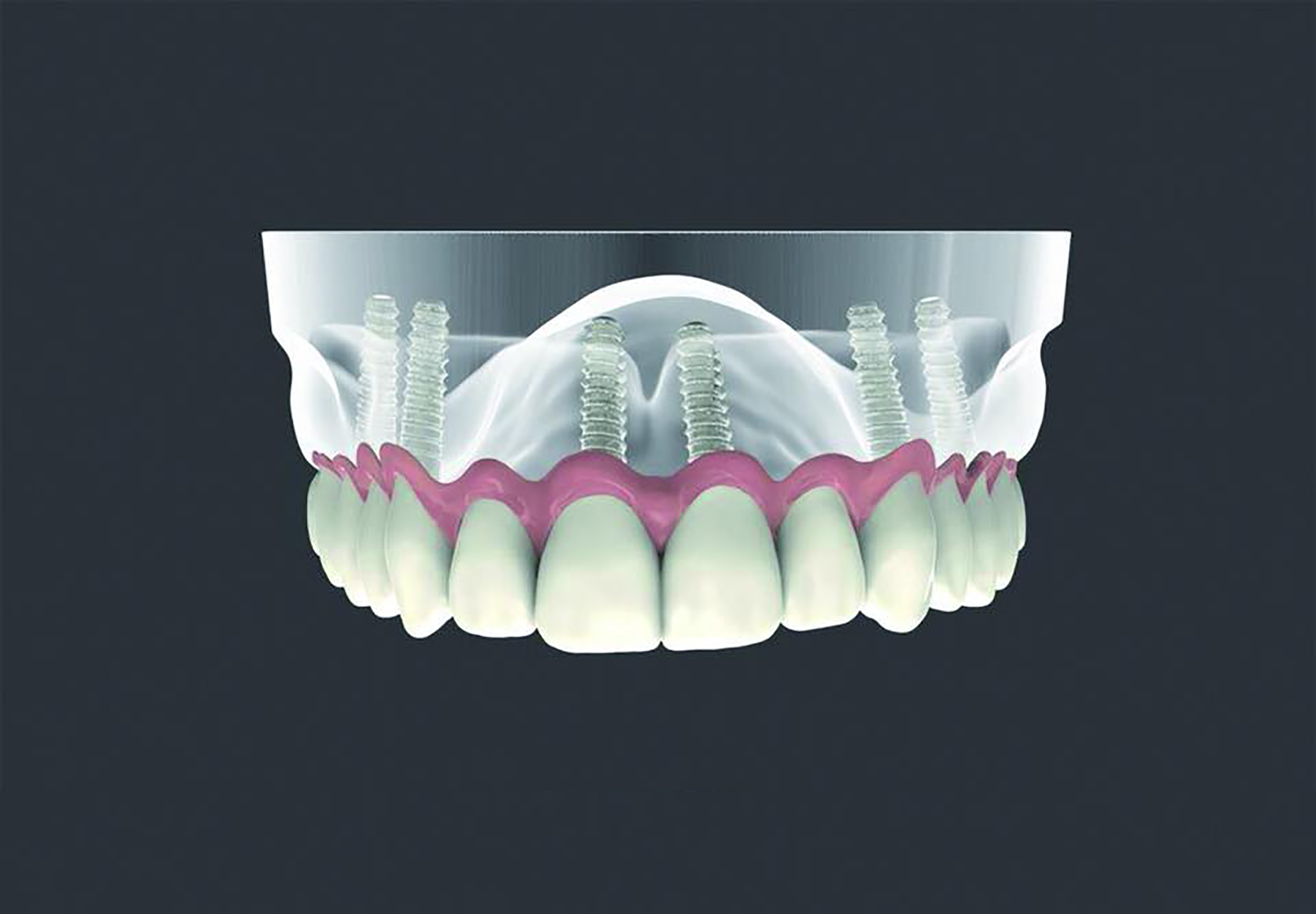 Diferencia entre los implantes dentales All On Four y All On Six