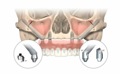 Así se colocan implantes dentales con poco hueso