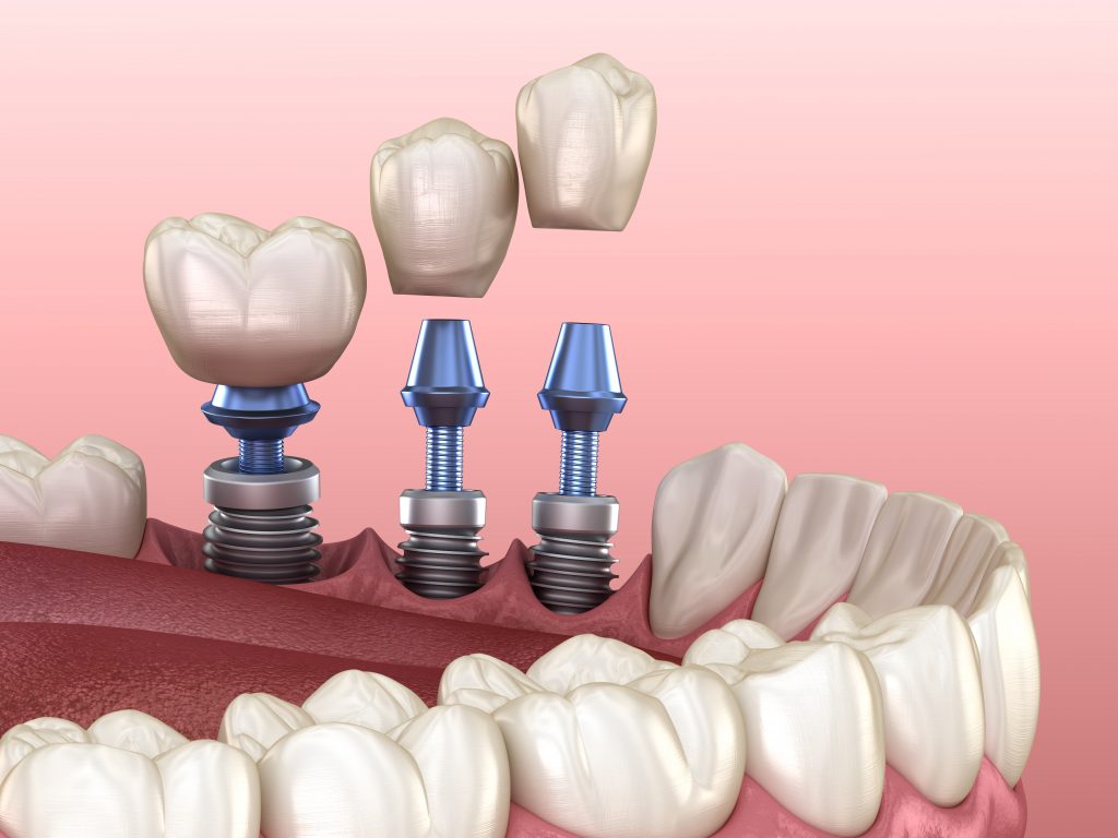 implantes-o-puentes-dentales-que-es-mejor-para-mi