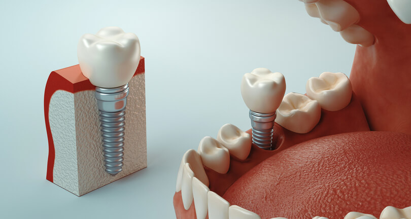 Principales síntomas del rechazo de un implante dental