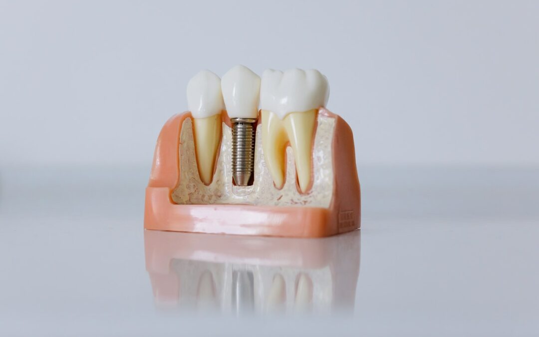El precio de implantes dentales de toda la boca