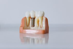 implantes dentales de toda la boca