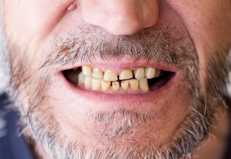 Las principales causas del desgaste dental