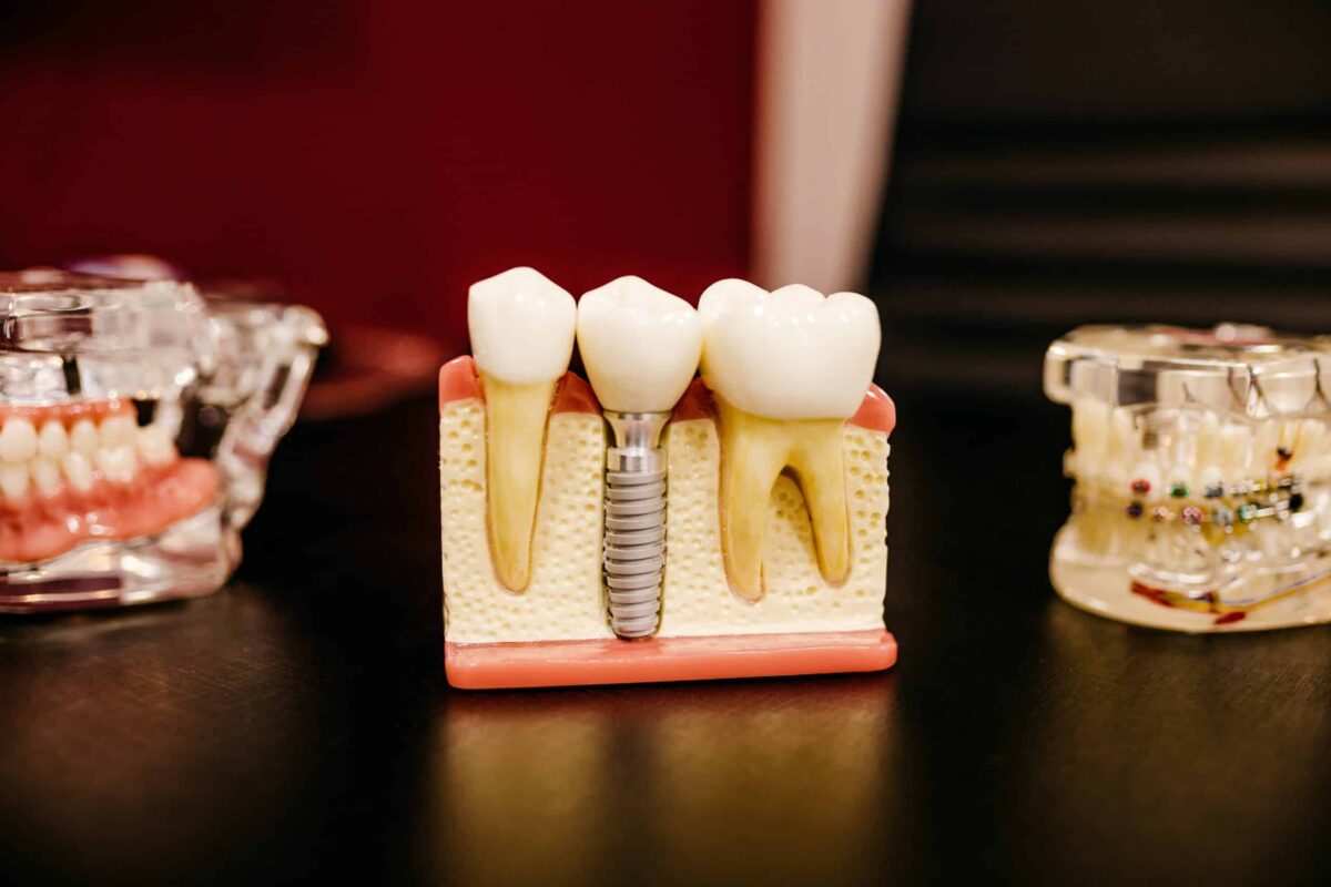 Qué es una corona dental, cuándo es necesaria y qué tipos hay