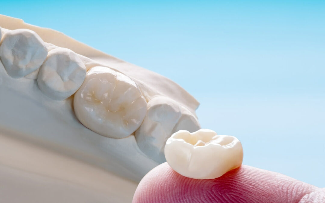 Coronas dentales ¿Qué tipos hay, en qué casos se usan y cuanto duran?