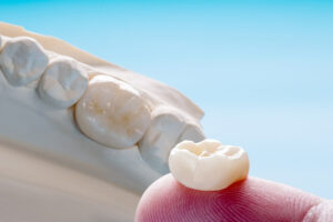 Coronas dentales ¿Qué tipos hay, en qué casos se usan y cuanto duran?