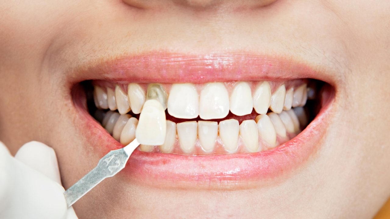 Cuándo usar carillas dentales?