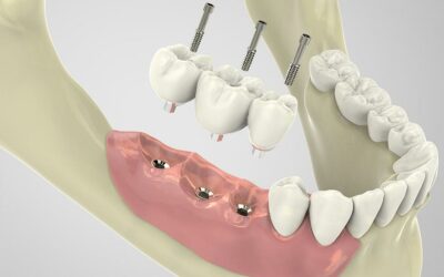 Precio de los implantes dentales en Asturias