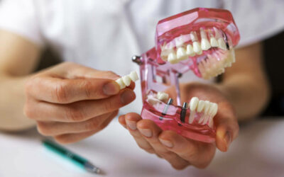 Puente sobre implantes dentales