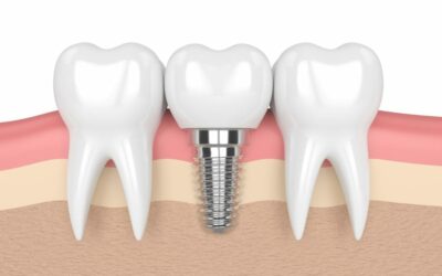 ¿Cuál es la edad mínima para colocar un implante dental?