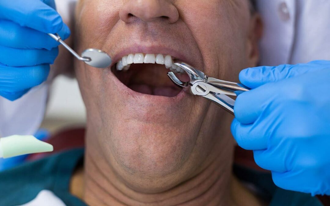 Capa blanca en la zona de las extracciones dentales
