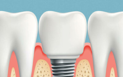 ¿Cuánto tiempo se tarda en poner un implante dental?