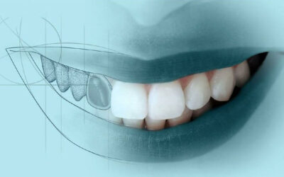 ¿Cuántos implantes dentales se necesitan para 4 dientes?