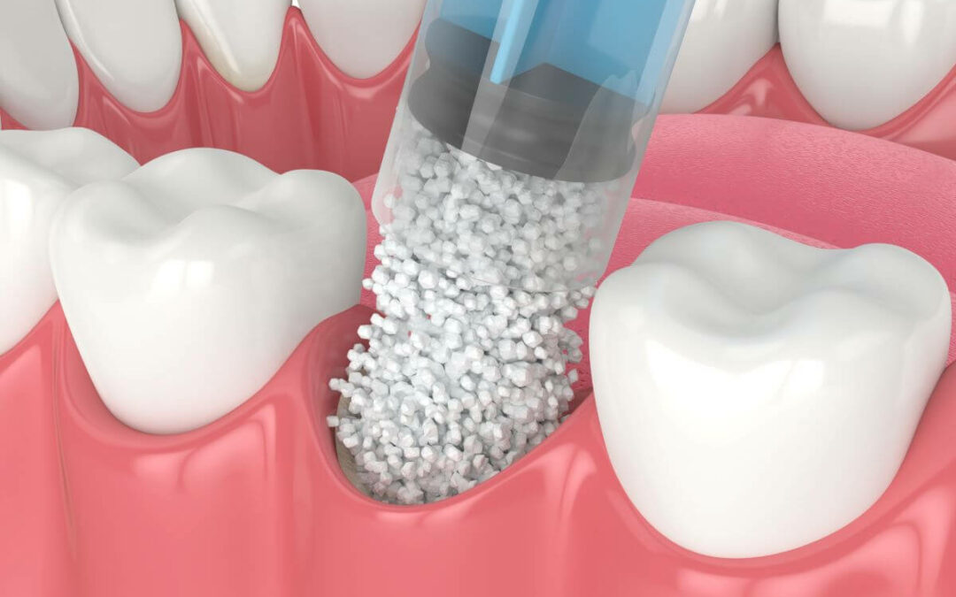 Elevación de seno maxilar para implantes dentales