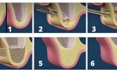 Precio del injerto de hueso dental