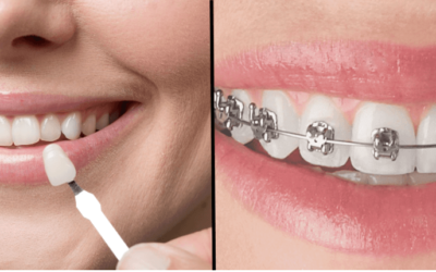 Carillas dentales vs ortodoncia