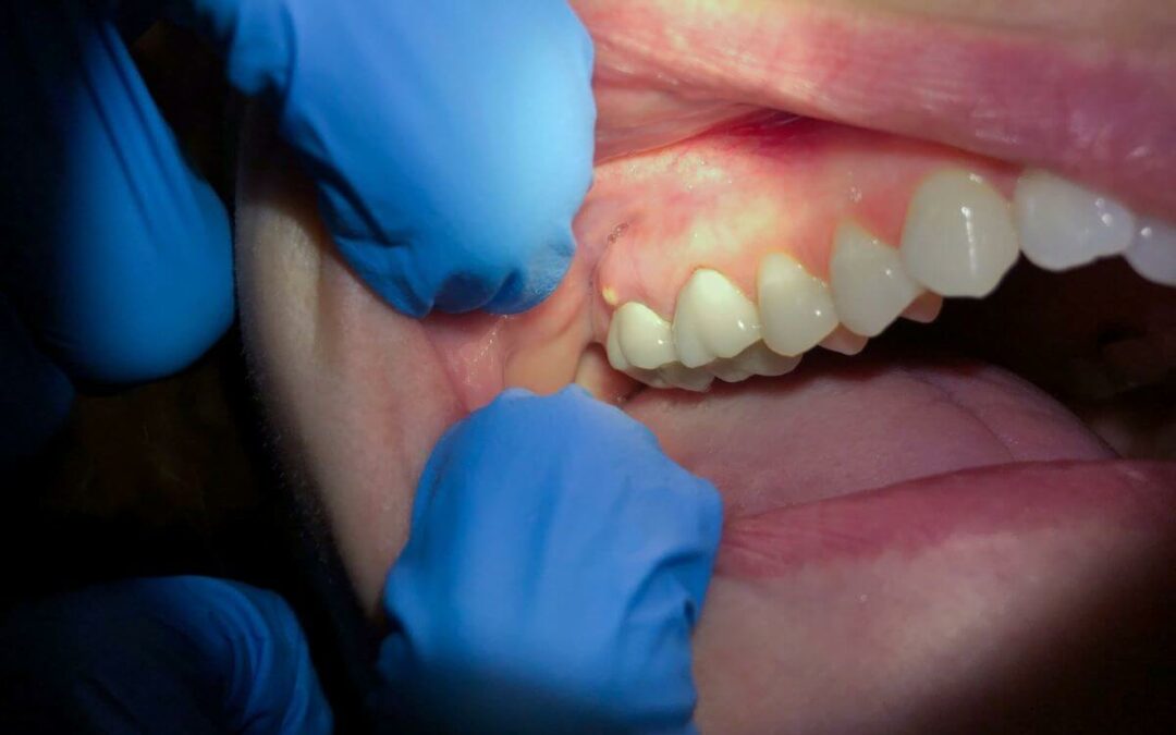 Absceso dental. Tratamiento y causas