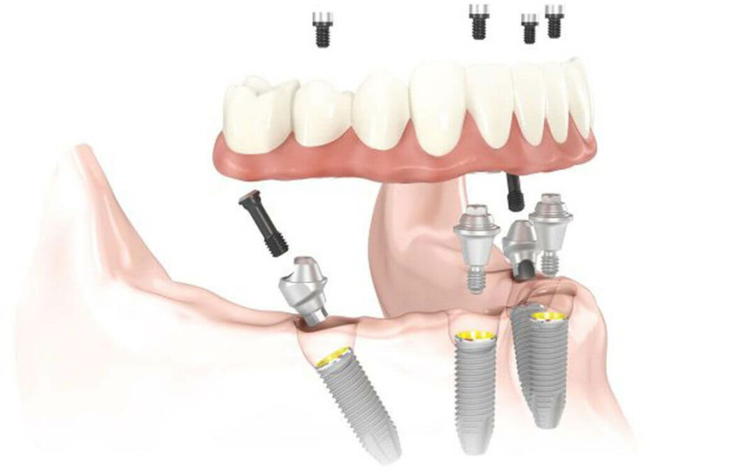 Implantes cigomáticos para maxilar inferior