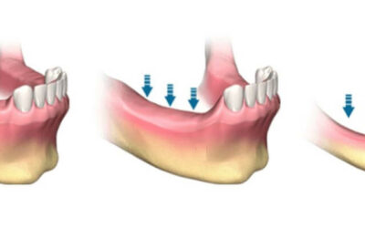 Por qué y en cuanto tiempo se pierde el hueso dental