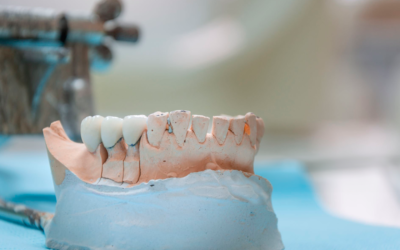 La osteointegración en implantes dentales en Gijón