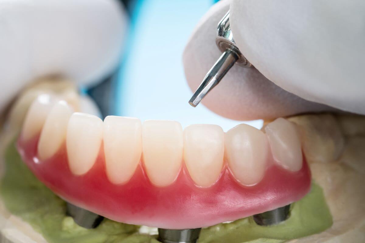 Prótesis Dental en Gijón