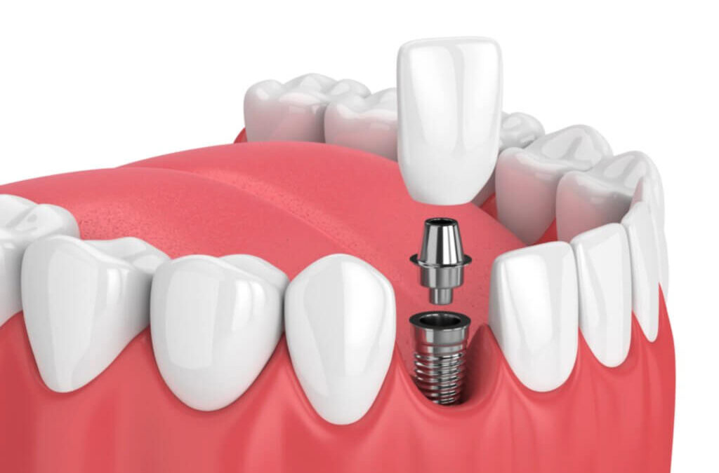 Implantes de conexión interna y externa