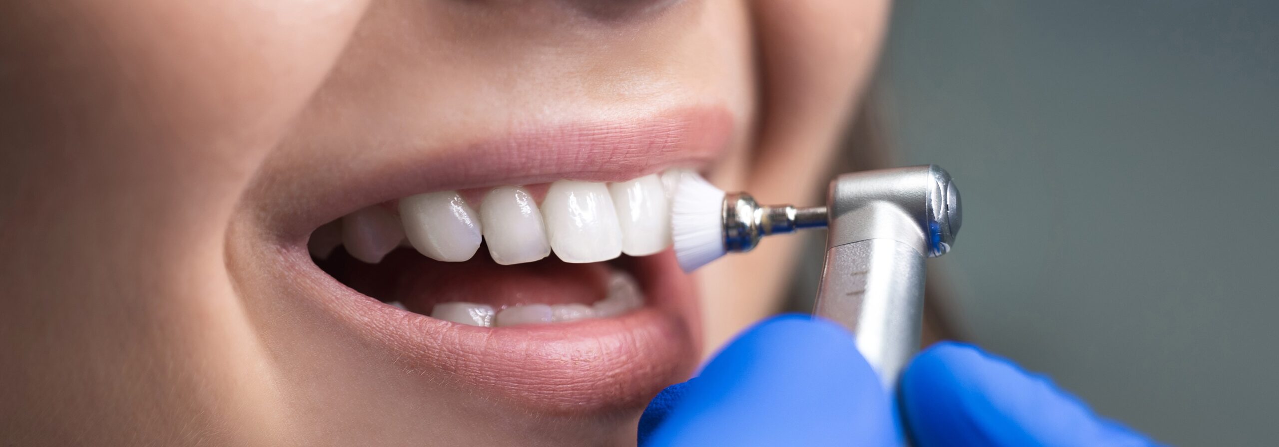 limp 1 Limpieza dental en Gijon