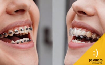 Ortodoncia invisible o brackets: qué opción es mejor para ti
